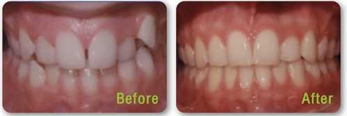 ตัวอย่าง การจัดฟัน Smile TRU เชียงใหม่